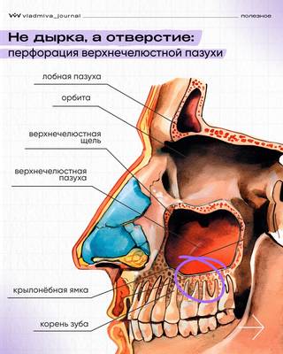 Перфорация гайморовой пазухи — риски и профилактика.